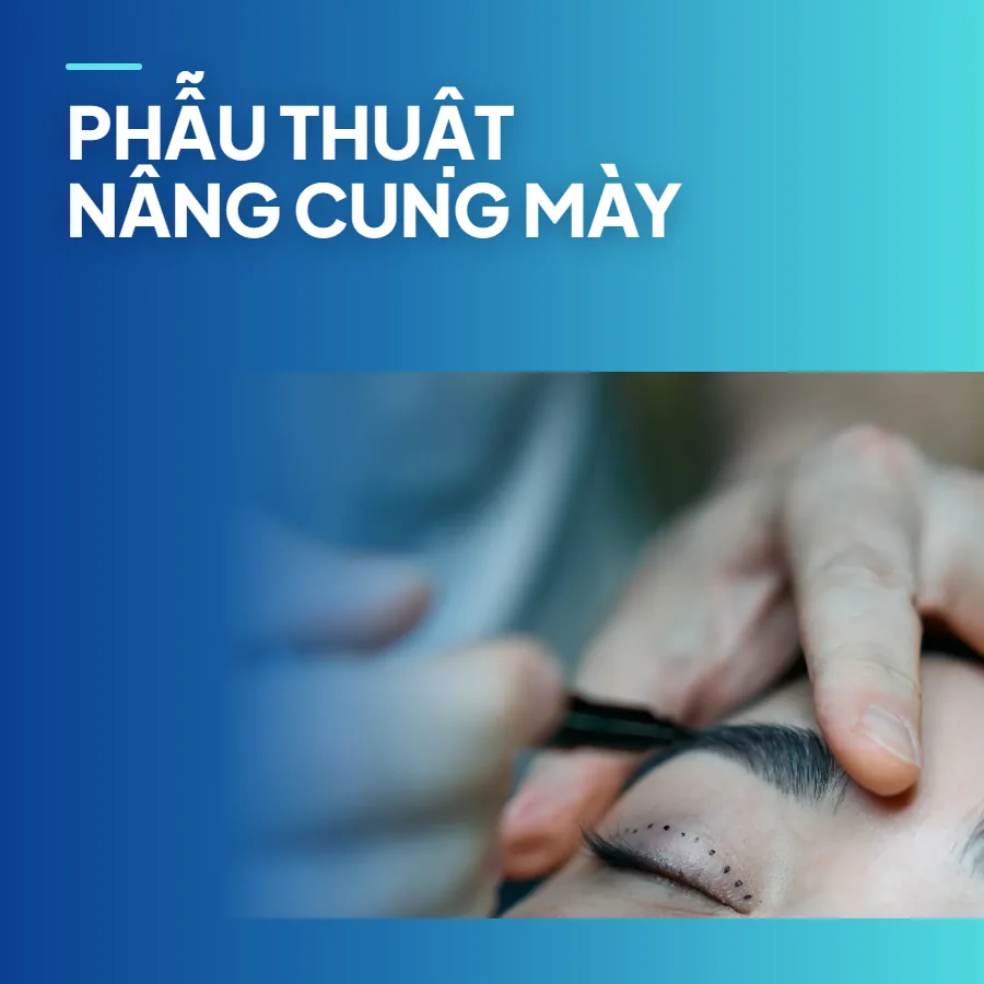 Phẫu thuật nâng cung mày – trẻ hóa vùng mắt