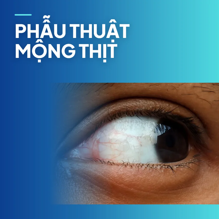 Phẫu thuật mộng thịt ghép kết mạc tự thân