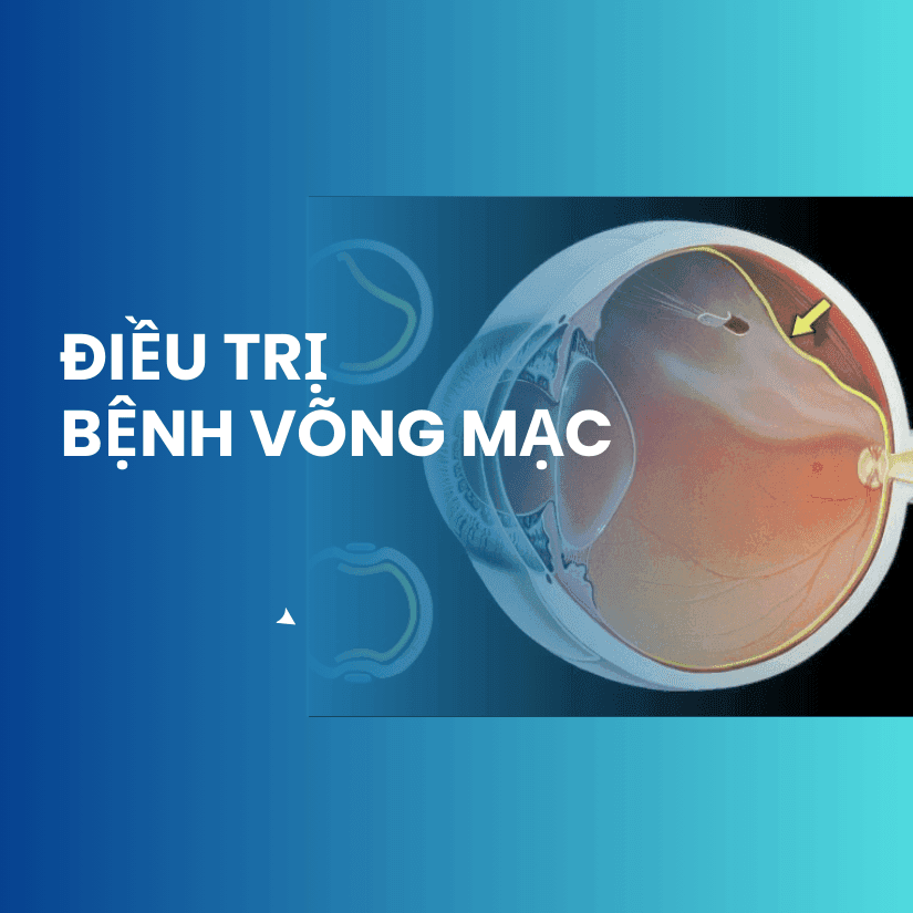Điều trị bệnh võng mạc – Bảo vệ thị lực với công nghệ hàng đầu